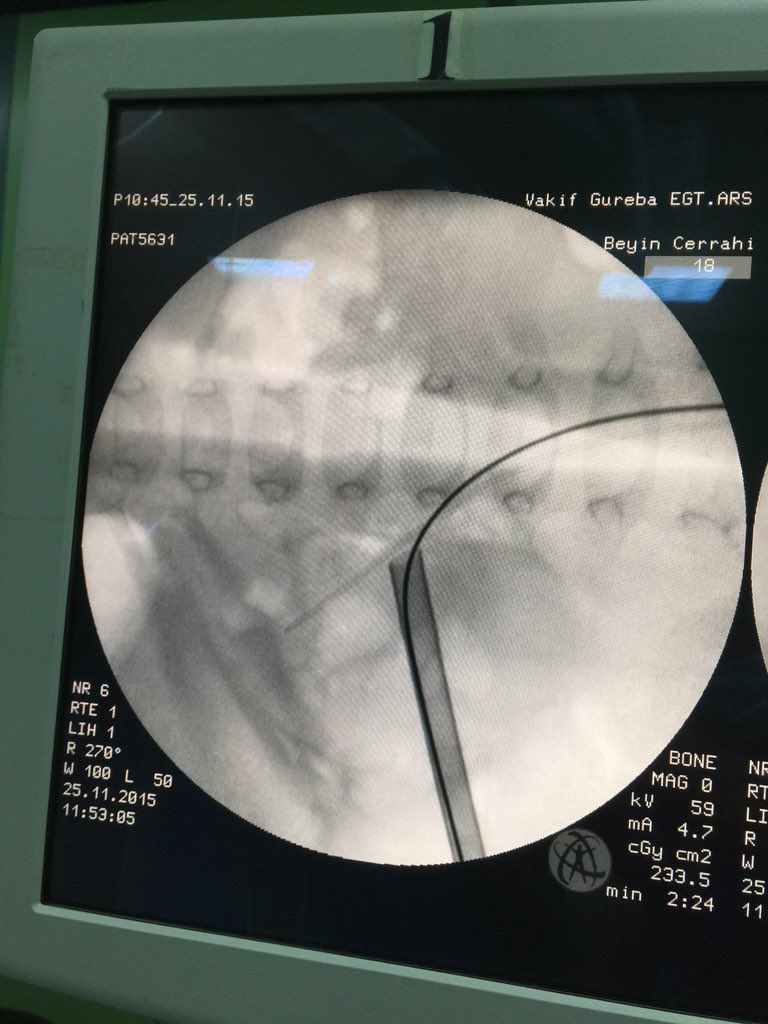 SelcukSilay's tweet photo. Pediatric kidney stones can be seen even <1 yrs old. #miniperc & #microperc allows success rates more than 90% https://t.co/mIoQaNaNpp