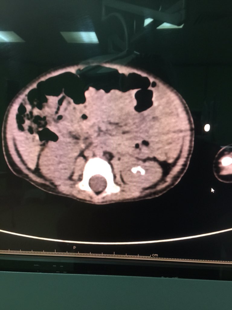 SelcukSilay's tweet photo. Pediatric kidney stones can be seen even <1 yrs old. #miniperc & #microperc allows success rates more than 90% https://t.co/mIoQaNaNpp