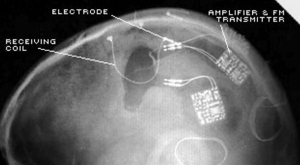 Neurosurgeon Had Brain-Computer Interface Installed In His Own Head - keepuinformed.com/neurosurgeon-h…