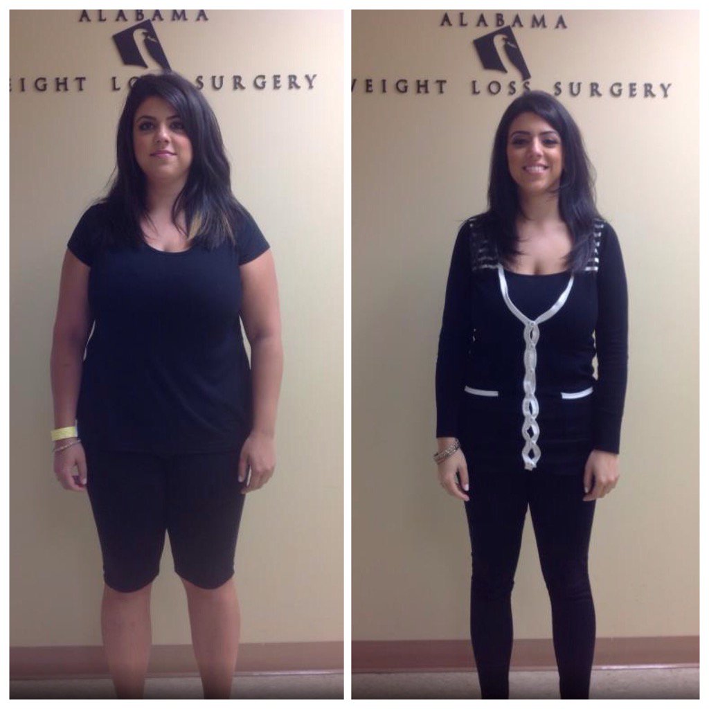 Alabama Weight Loss Surgery Birmingham Alabama WeightLossLook