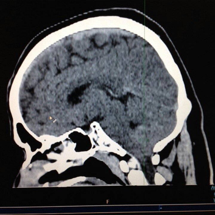 fadlizdno95's tweet photo. Gifted from HIM .. Syukur Alhamdulillah #ctscanbrain 😊 https://t.co/3bpPQNcgc3