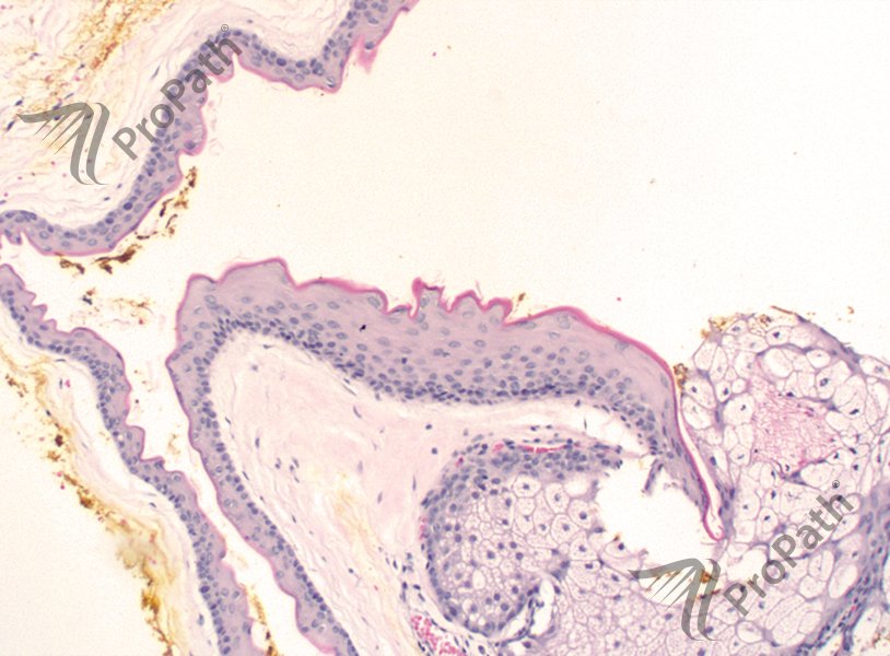 Ryan Hick MD On Twitter Steatocystoma clue Corrugated Pink Cuticle 