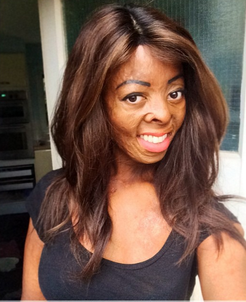 Raiché Mederick: My experience of living with a different appearance from a young age survivingfacialburns.wordpress.com/2015/12/05/rai…