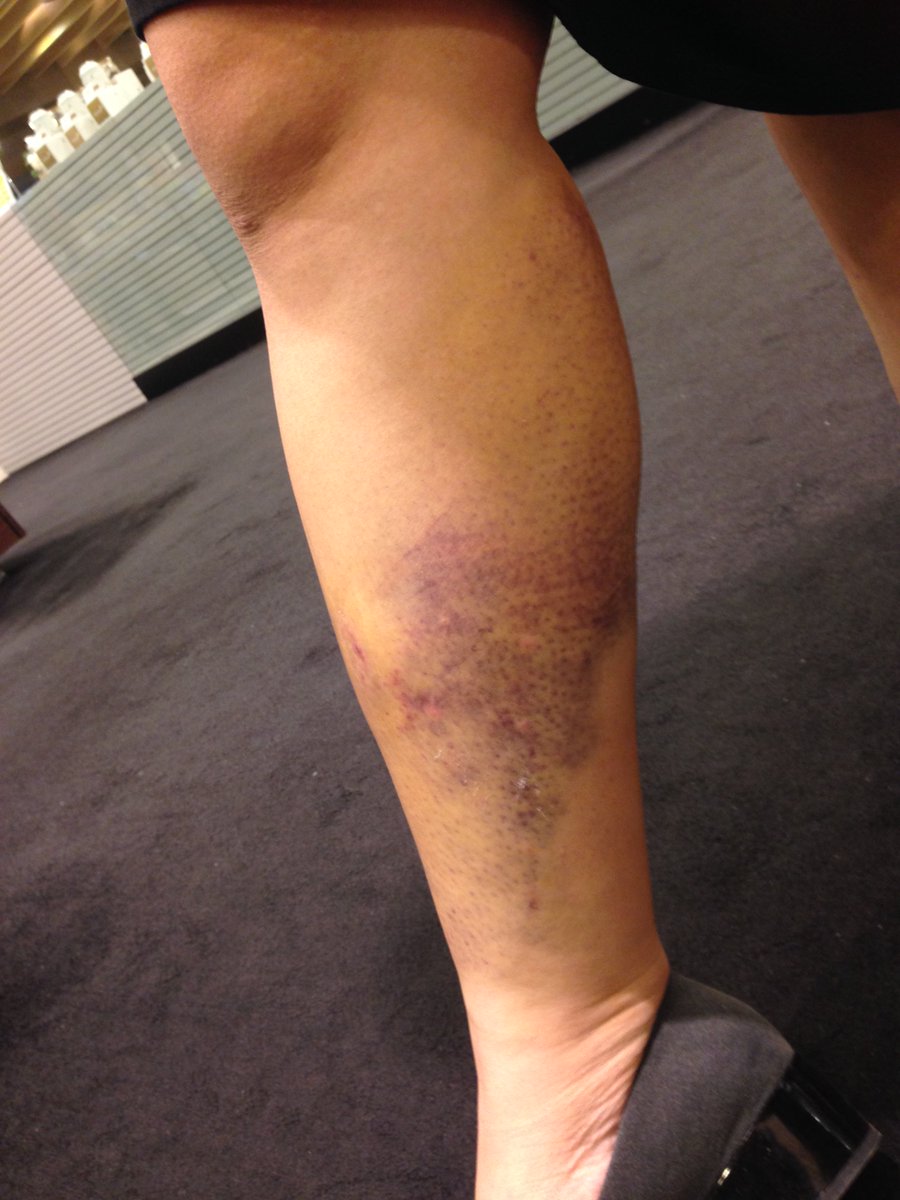 erica_ueno's tweet photo. Pain of the bruise has caused a barrier from starting to exercise. @SPHPCOR #PCORseek #GroupO https://t.co/qcPeTBBaqA