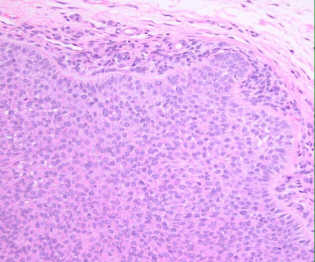 RyanneMDMBA's tweet photo. Trichilemmoma pearl from Dr. Chanda Smart: look for thickened basement membrane #CSP68th @capath https://t.co/b68bzI6poQ