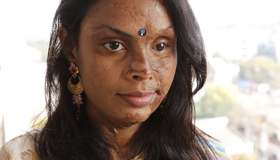 "I'm sharing my story for all the acid survivors in Bangladesh." More from Monira: ow.ly/Vv1Dz #16Days