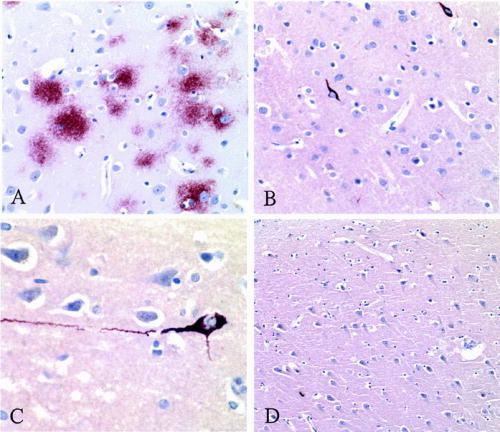 The plaques &amp; tangles @bennetomalu9168 reported in 1st paper ncbi.nlm.nih.gov/pubmed/15987548 <a href="/Pathologists/">CAPathologists</a> #ConcussionMovie