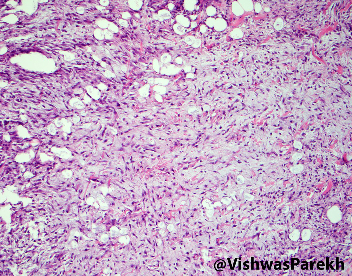 VishwasParekh's tweet photo. Nodular #Fasciitis:Feathery stroma, thick collagen, RBCs, "Cell culture" myofibroblsts #USP6-#MYH9 fusion #pathology https://t.co/XfVAgQt7qn