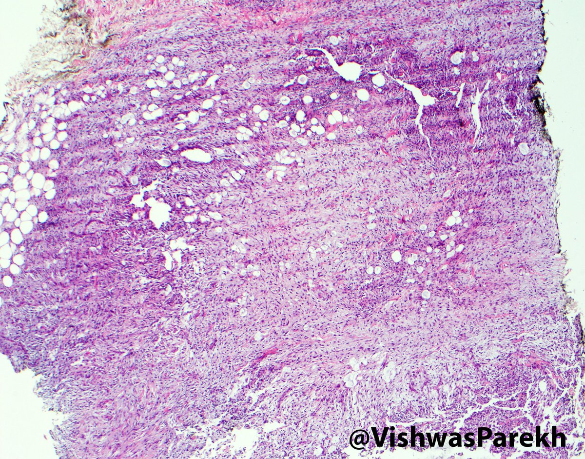 VishwasParekh's tweet photo. Nodular #Fasciitis:Feathery stroma, thick collagen, RBCs, "Cell culture" myofibroblsts #USP6-#MYH9 fusion #pathology https://t.co/XfVAgQt7qn