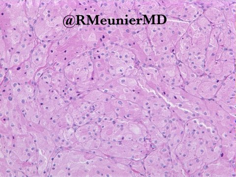 CancerCureNow's tweet photo. MT/RT @RMeunierMD 
Granular cell tumor of the finger 
#pathologists #pathology 
https://t.co/Ab3vd6vMAD 
https://t.co/1kv8RaZ3jE