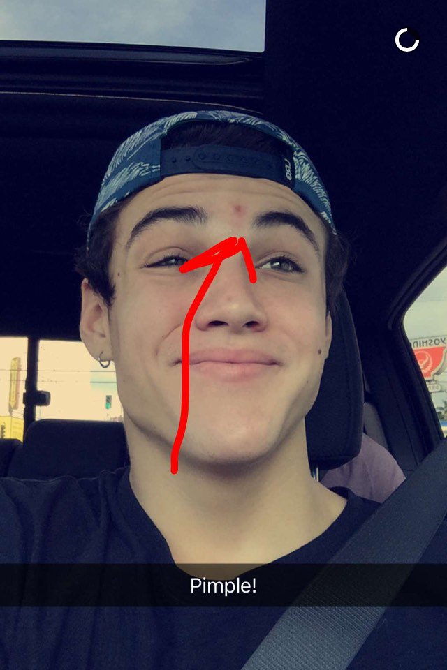 emileedsz_'s tweet image. pimple life #pubertyproblems