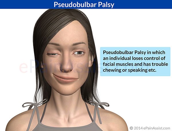 Palsy pseudobulbar Treatment for