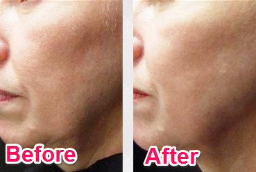 LAVitiligo's tweet photo. Before and After of a patient who received the Katalaya Peel. #katalayapeel #skincare #dermatologist #katalaya https://t.co/eh15OEuWlX