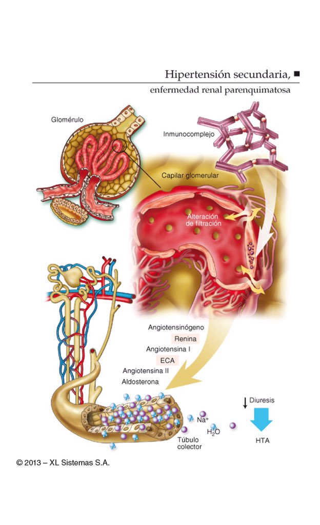 Enfermedad renal con hipertensión Enfermedad renal con hipertensión
