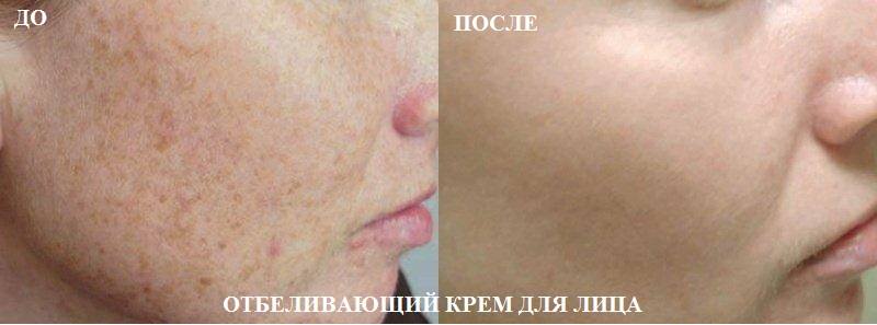 termecos's tweet photo. Отбеливающий #крем для #лица который реально помогает https://t.co/x1Q3sHK4V2 https://t.co/TtEP1GKfpF