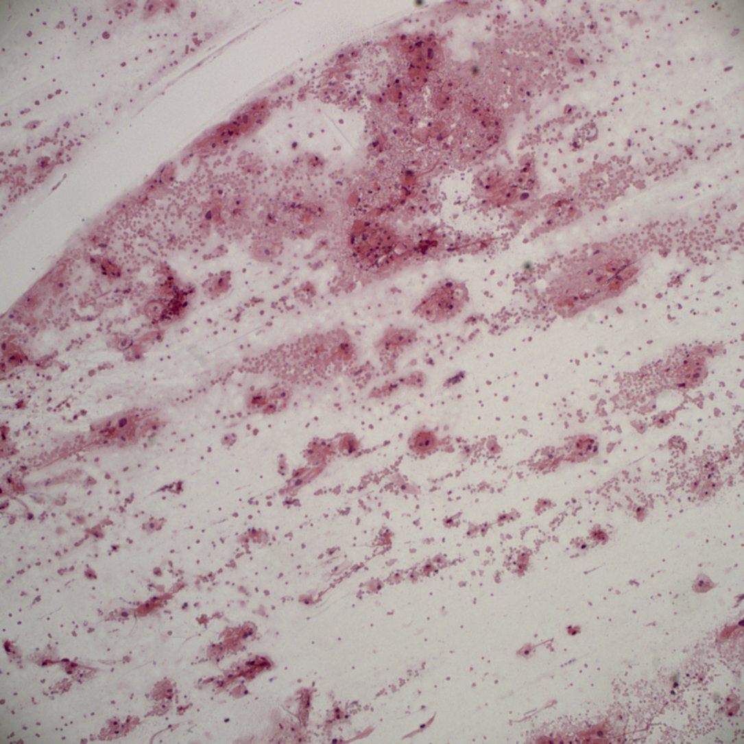 Pathoutlines's tweet photo. New Case! https://t.co/i7eTv24iOC, #Neuropathology, #CNStumor https://t.co/kdCySz3Z2r