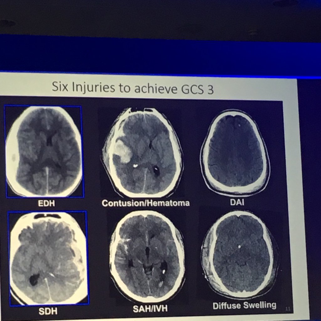 icu_dave's tweet photo. Andrews: 6 ways to achieve GCS3 in traumatic brain injury #icssoa2015 #FOAMEd #FOAMcc https://t.co/73iYBcPwRs