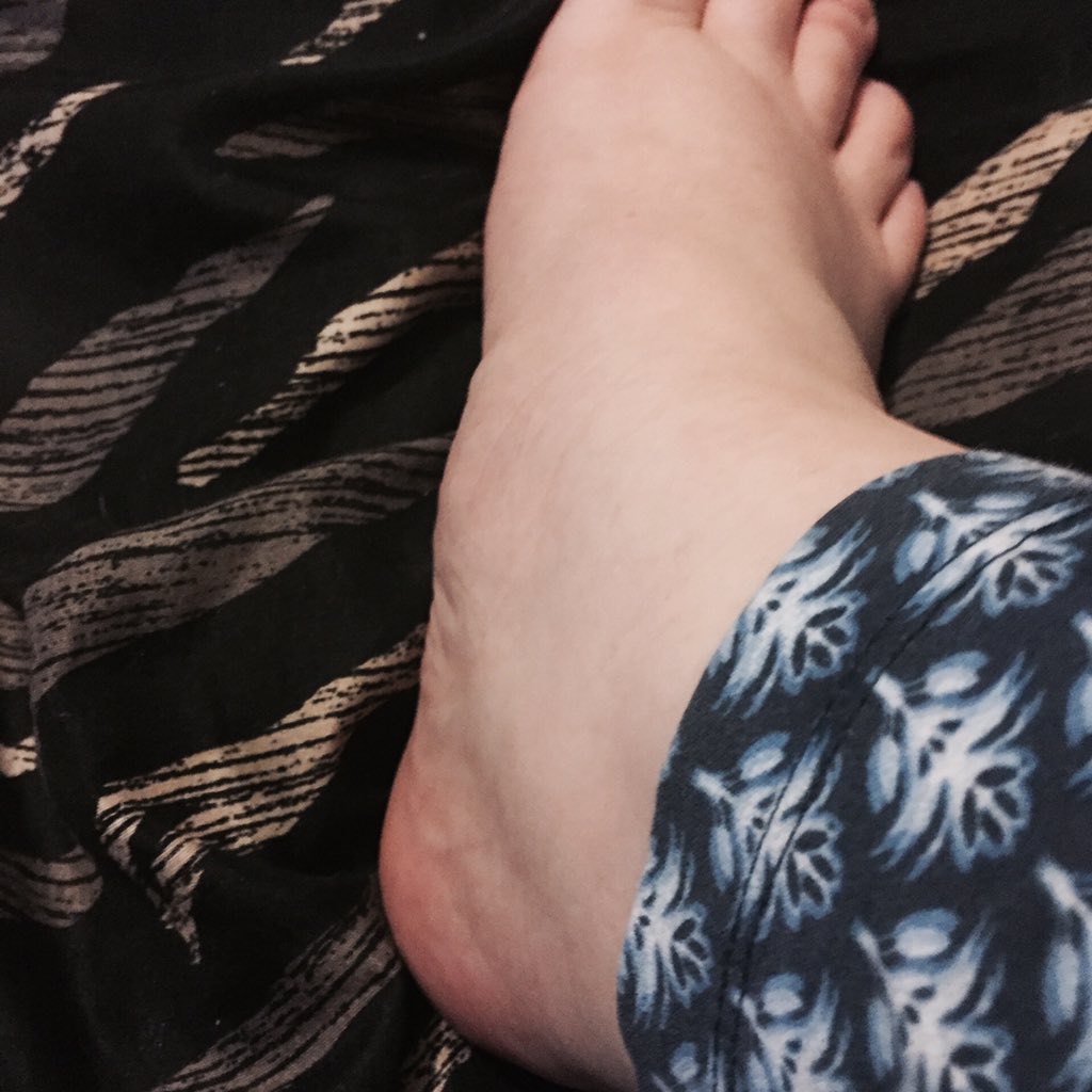 Melioraaa's tweet photo. One swollen foot. That lump on the left side is a bone anyone else in the #accessorynavicular club? https://t.co/LPS5jMgepT