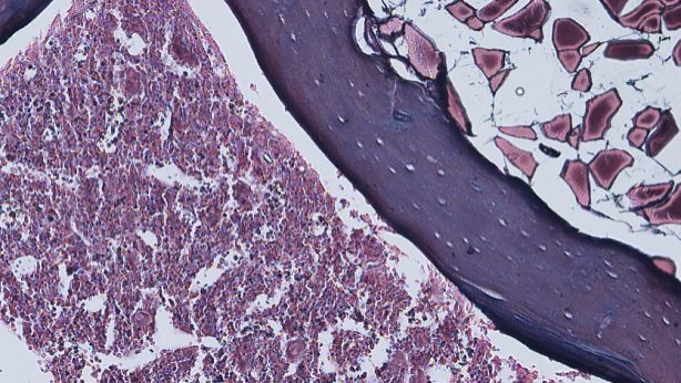 La expresión de AIRAPL está suprimida en pacientes con síndromes mieloproliferativos bit.ly/1mxOpI7