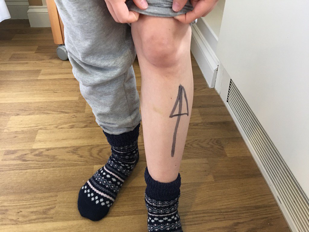 tonybooth75's tweet photo. Funny that they have to use a permanent marker #gottobesure All the best for the op Lucy! #bebrave https://t.co/cwtwLZQoqO