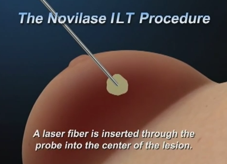 drseisenberg's tweet image. Novilase laser treatment shows promise for early-stage #breastcancer instead of #lumpectomy buff.ly/1Rf2Nl3…