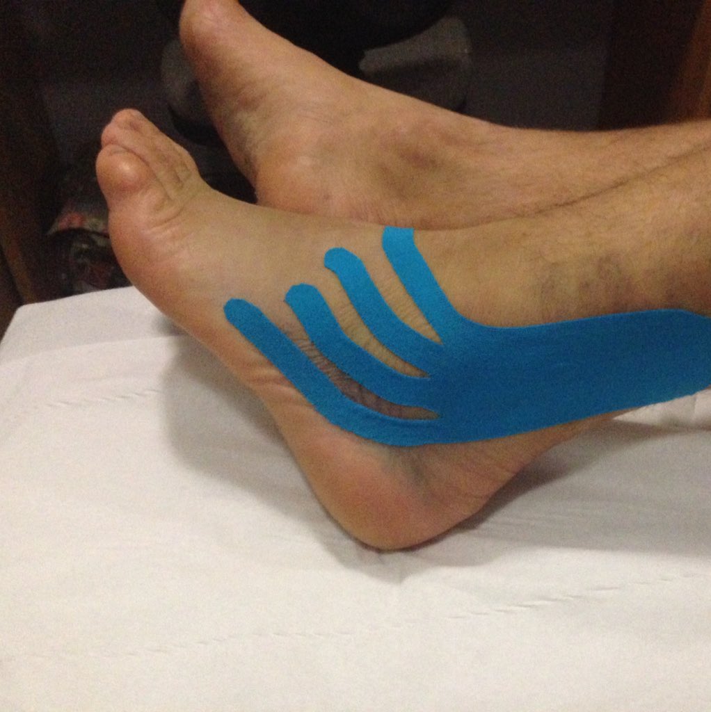 rivendalephysio's tweet photo. Some interesting k taping this week for a nasty ankle sprain... Has helped with the swelling and bruising. https://t.co/eaHsaAJ1Fd