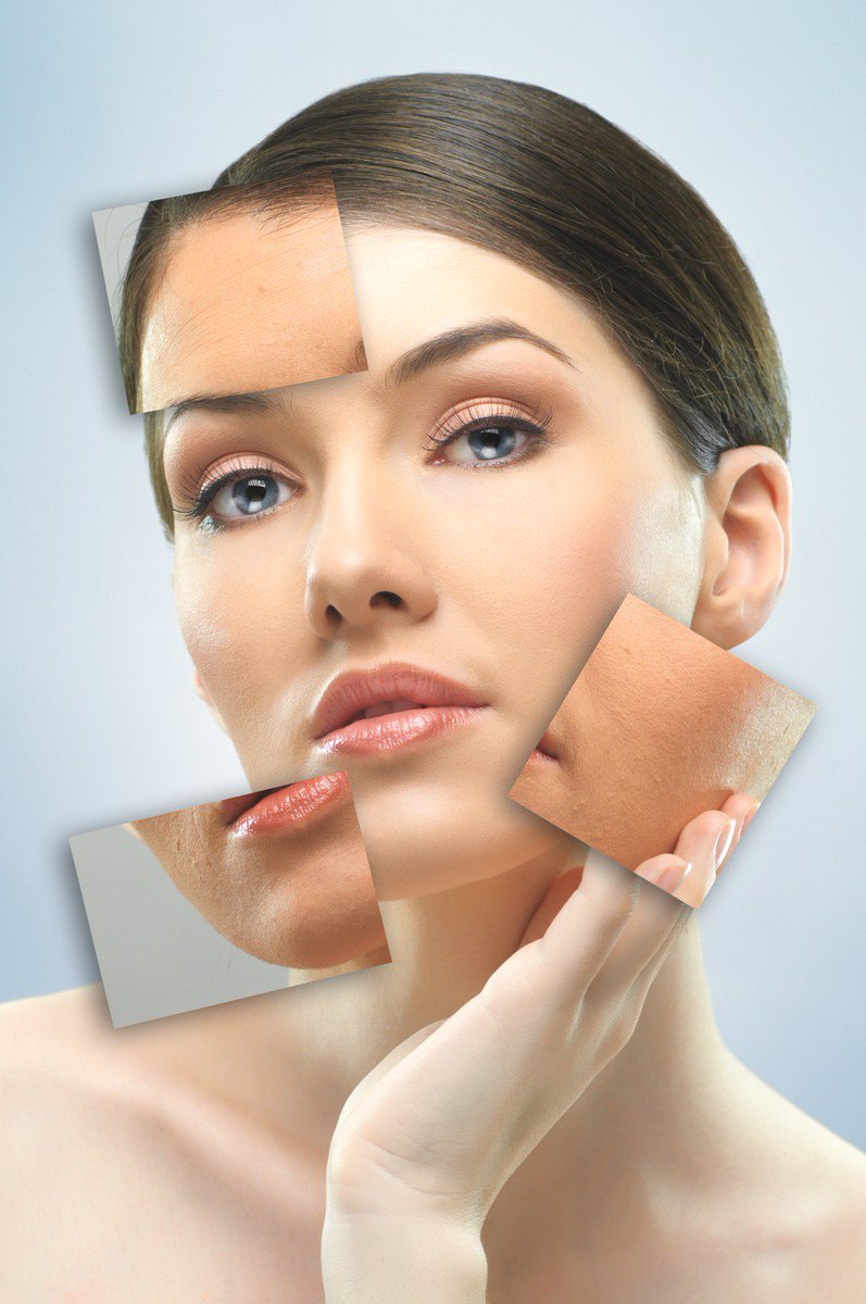 BeautyVivacious's tweet photo. We offer Acne Treatments.  Call for more details (519) 415-4247 https://t.co/EYSgZNdMOe