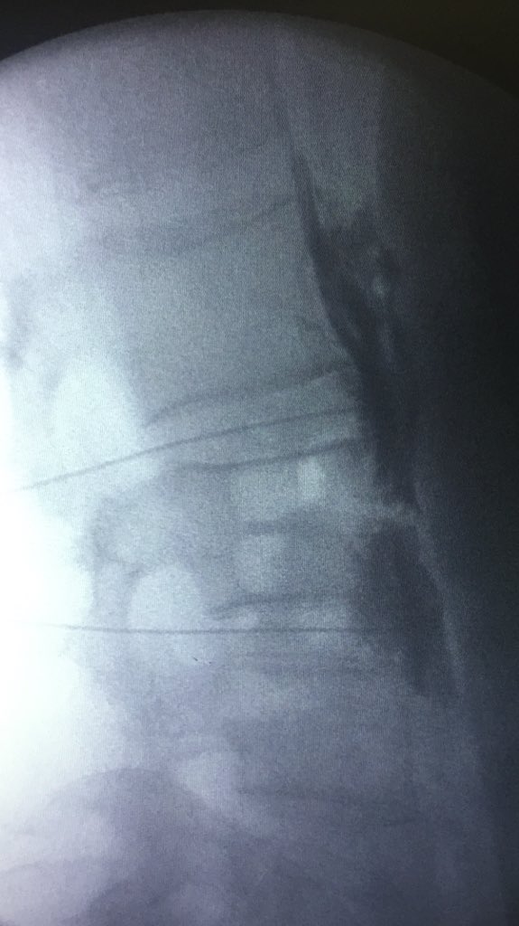 manejodeldolor's tweet photo. Simpatectomia lumbar para síndrome doloroso regional complejo #fightpain #painblocks https://t.co/tduW1AAgka