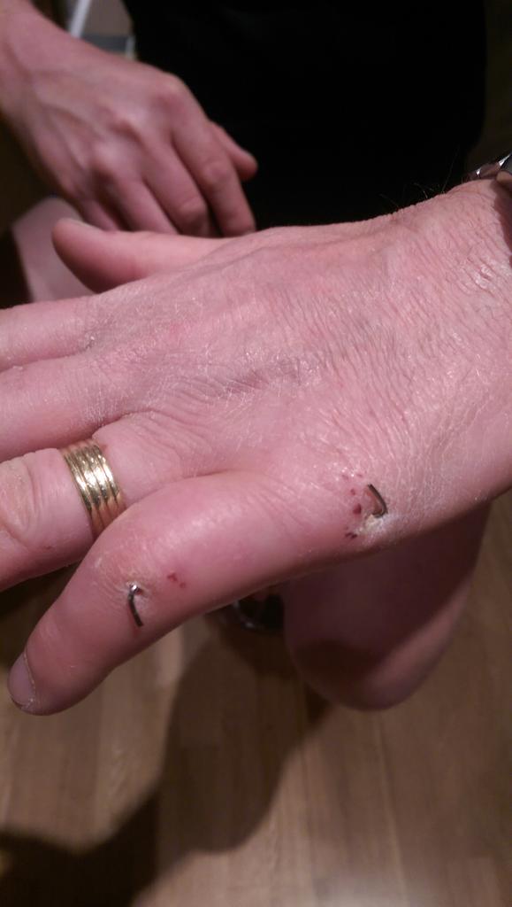 jifforugby's tweet photo. @obrien2612 now that's a fucked finger, 3rd time thanks to @boulton_charlie , #clumsygit https://t.co/HJx5KLm1A1