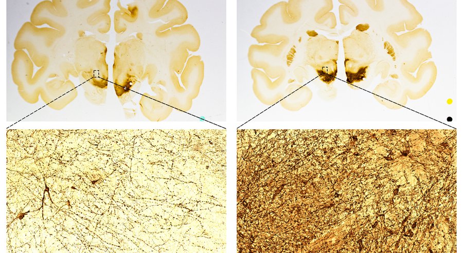 pknoepfler's tweet photo. Parkinson’s stem cell therapy OK’d for testing https://t.co/llgsz9lO3N @sandiegoscience #stemcells https://t.co/sE0fH4cstG