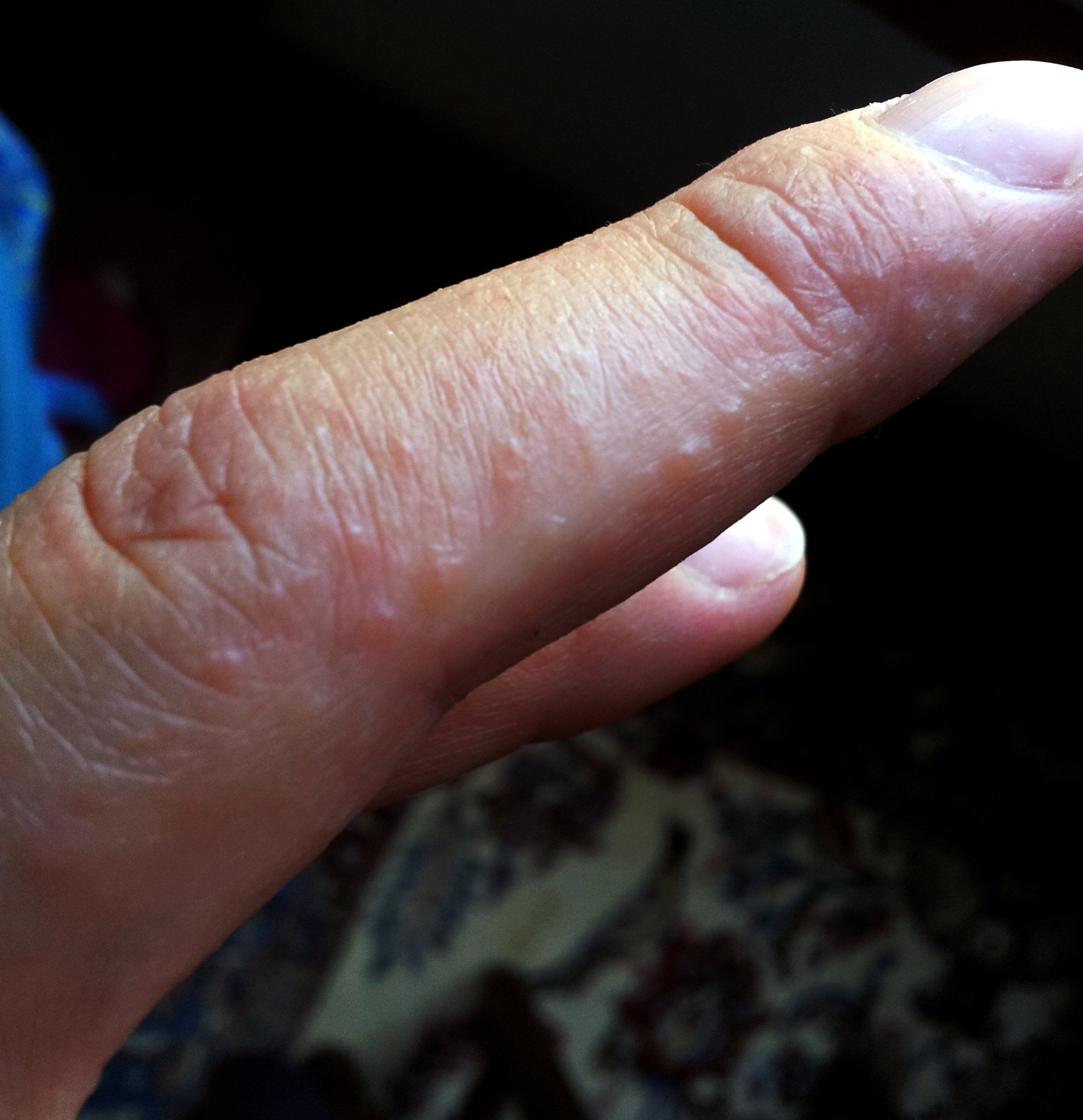 Dermatitis herpetiformis adalah