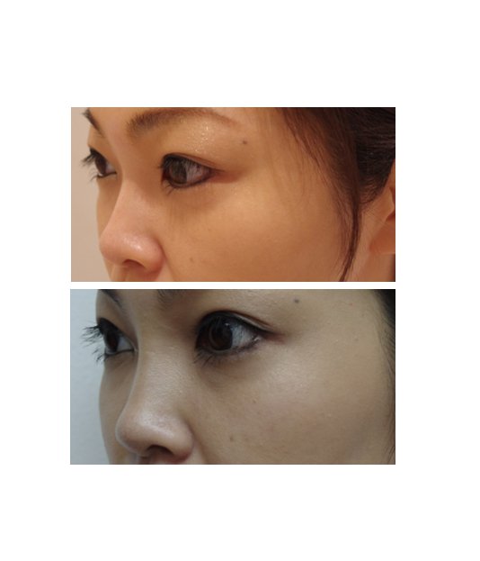 渋谷の森クリニック على تويتر ヒアルロン酸で簡単プチ整形 注射1本で手軽に憧れの顔を手に入れませんか 涙袋形成や 鼻や輪郭に注入し外人さんのようなシャープな顔を簡単に手に入れることができます 渋谷の森クリニック ヒアルロン酸 涙袋 整形 プチ整形