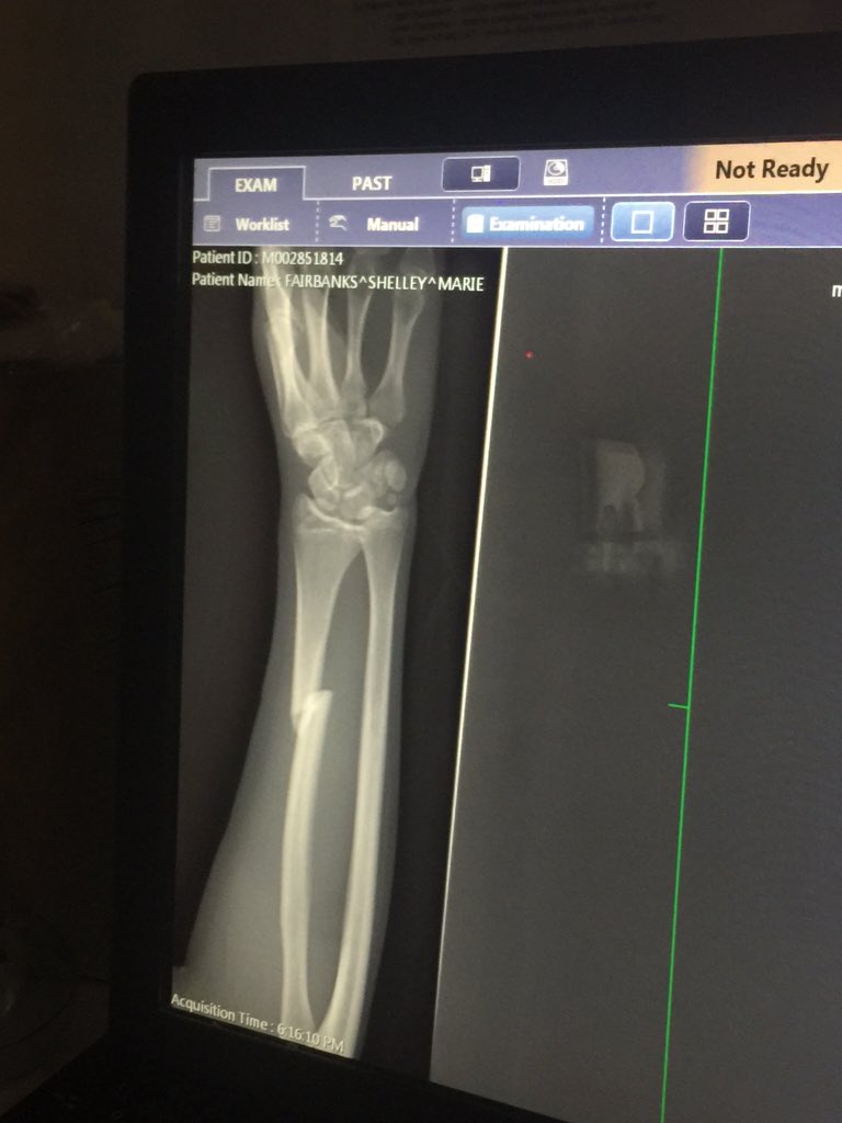 Shellfairbankss's tweet image. This is going very well🙂 #brokearm#brokewrist