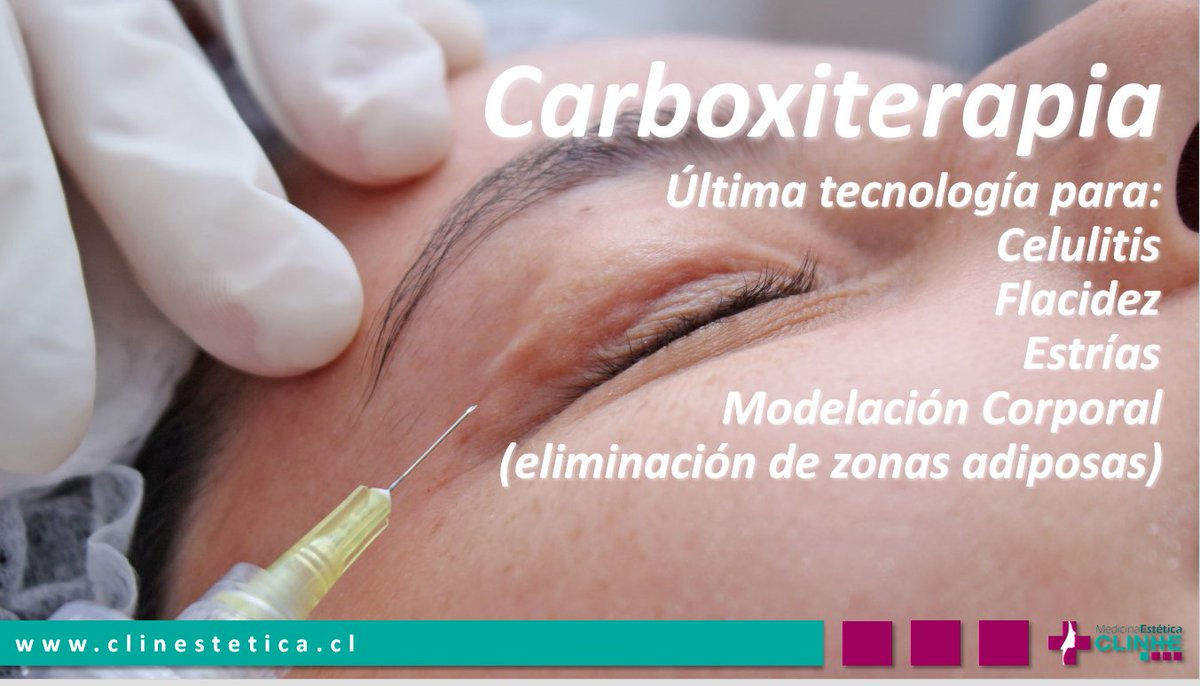ClinEstetica_cl's tweet photo. #Carboxiteriapia Efectiva técnica de mínima punción subcutánea de Co2 (NO químico) oxigena piel en zonas de lesión! https://t.co/Sn0VRvcy0P