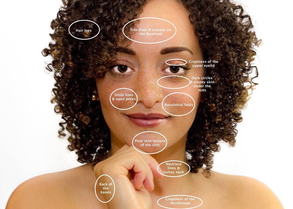 NWWstudios's tweet photo. PRP #skinrejuvenation #plateletrichplasma #therapy #NWWstudios #StAsaph https://t.co/P3leeYo4fa