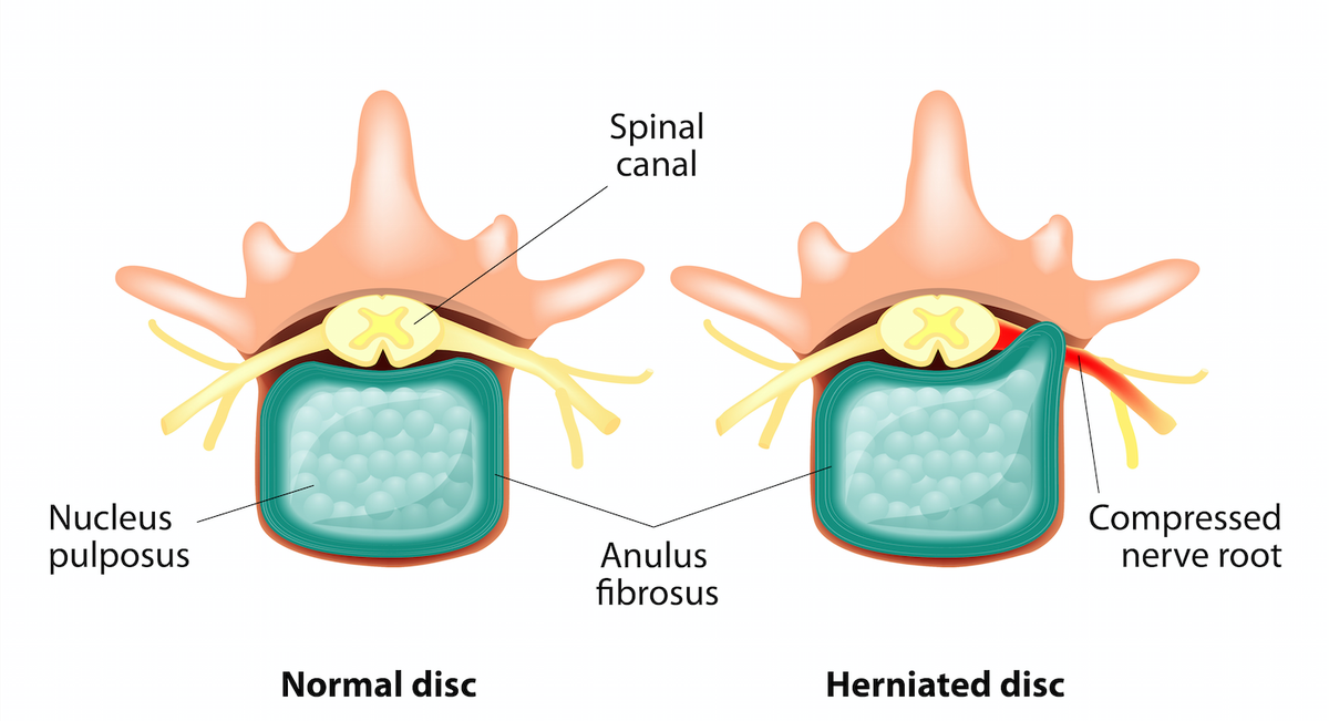 VNeurosurgery's tweet photo. What is the difference between #bulgingdisc and #herniateddisc? Find out here.
https://t.co/Y1tzGBauNl
#backsurgery https://t.co/ussDLuikzg