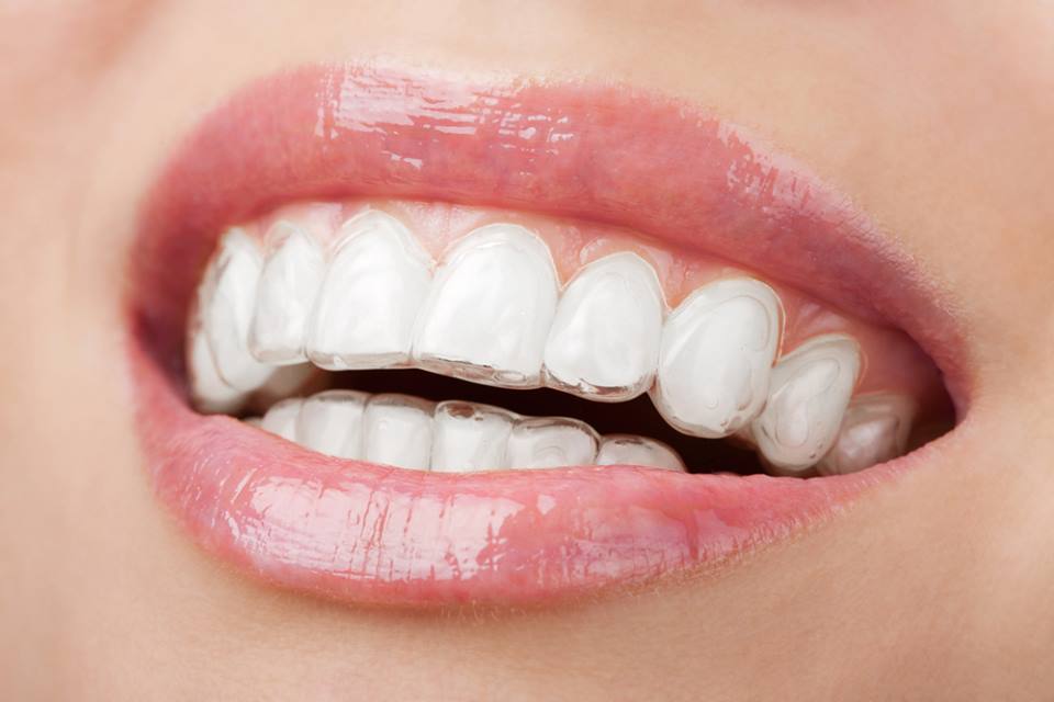 OpticianEdin's tweet photo. Shhhhhh! Invisalign straightens your teeth secretly. https://t.co/SeIbtz53A5
