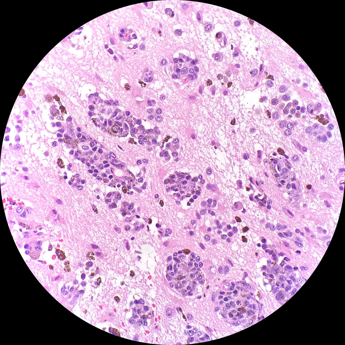 pathtutor_com's tweet image. Brain: Metastatic Melanoma @JMGardnerMD @recutclubdotcom @JennyKHoang @syntheslide @GeronimoJrLapac @NejibY