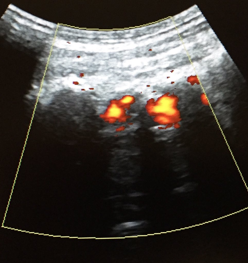 ceredesport's tweet photo. en #cervicalgias Importante valorar con #US_MSK la arteria vertebral https://t.co/ZzVGL8XPO6