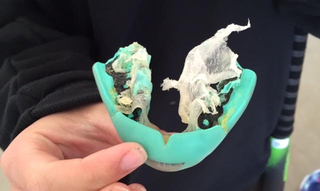 iMouthguards's tweet image. Tag somebody who's mouthguard looks like this? #nastymouthguards #fieldhockey #notprotected