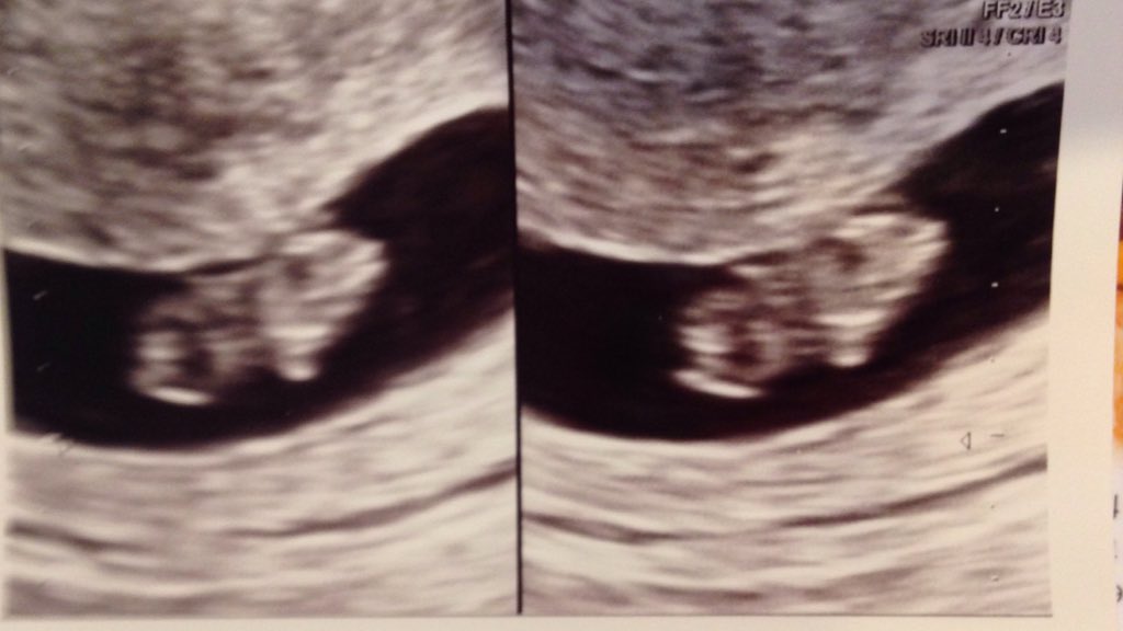 _ohioprincess's tweet image. 8 weeks and 4 days 🙈 I'm gunna be a mommy! 👶🏼😍❤️