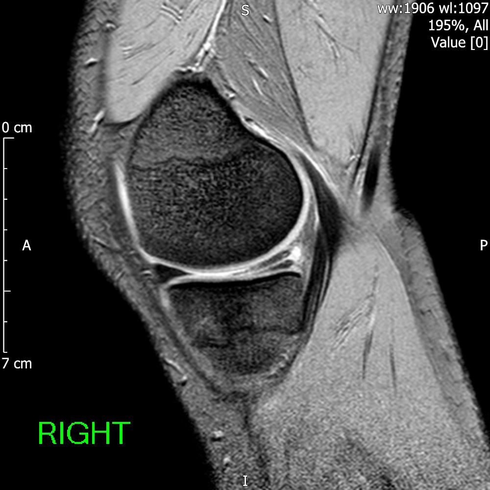 feet2knees's tweet photo. Advantages of MR difficult to beat - see this coexistent medial meniscal tear and medial tibial stress fracture. https://t.co/qss8LmmE1t