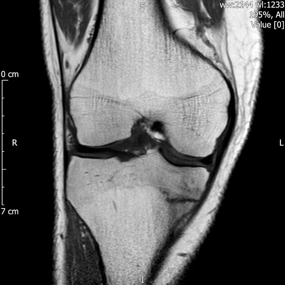 feet2knees's tweet photo. Advantages of MR difficult to beat - see this coexistent medial meniscal tear and medial tibial stress fracture. https://t.co/qss8LmmE1t