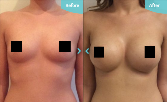 privateclinic's tweet image. Unsurprisingly, '#BoobJobs' are the most common #PlasticSurgery procedures in the UK and the USA.