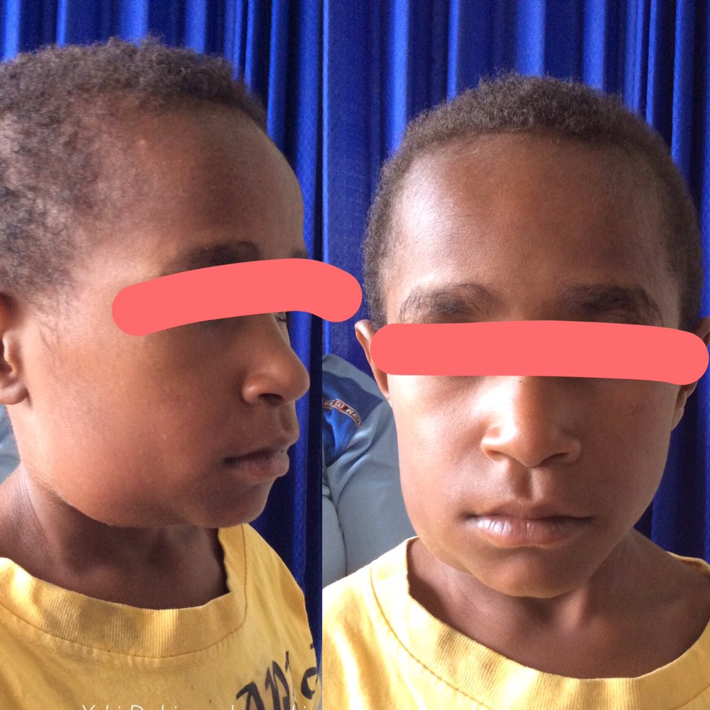 soalUKDI's tweet photo. Benjolan sejak 3 hr, tunggal, nyeri, panas, konsistensi keras, immobile. Diagnosis? https://t.co/ZISnttp3PB