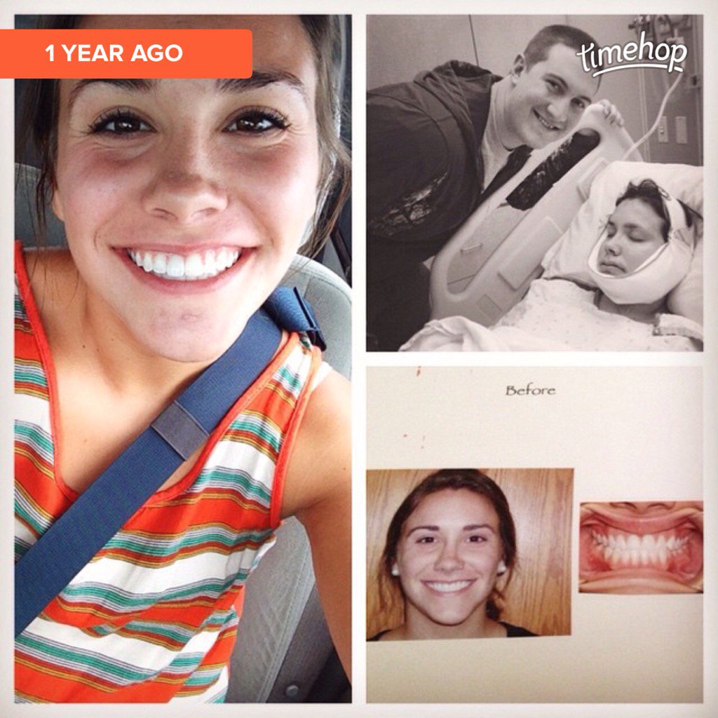 b_lindstrom11's tweet photo. Two years ago the underbite was put to rest #ripunderbite 👋🏼 https://t.co/fDl7LN79fo