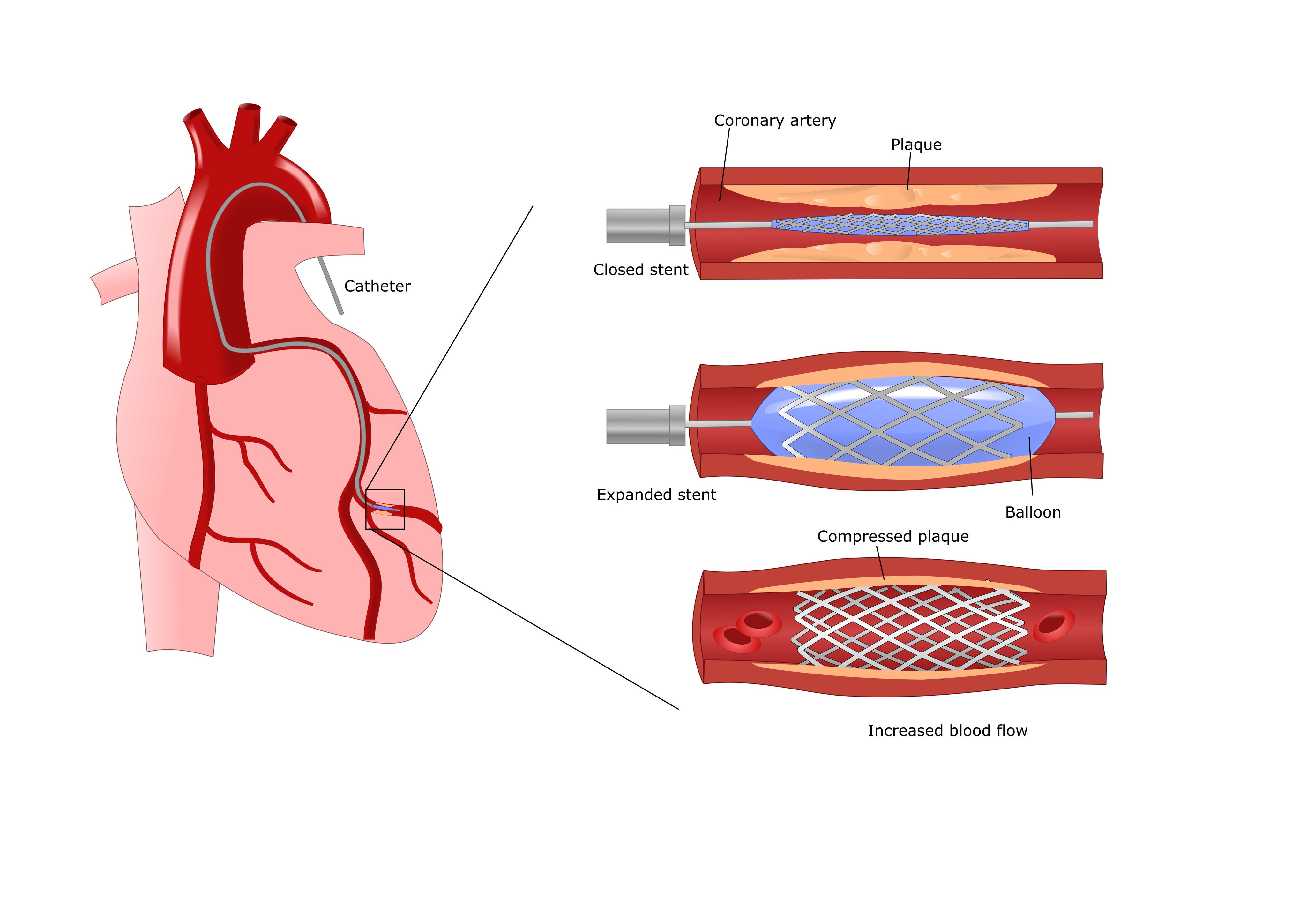 Замена стентов. Стентирование коронарных артерий сердца. Стентировние корнараеыц атерии. Операция стентирование сосудов сердца. Коронарных сосудов после стентов.