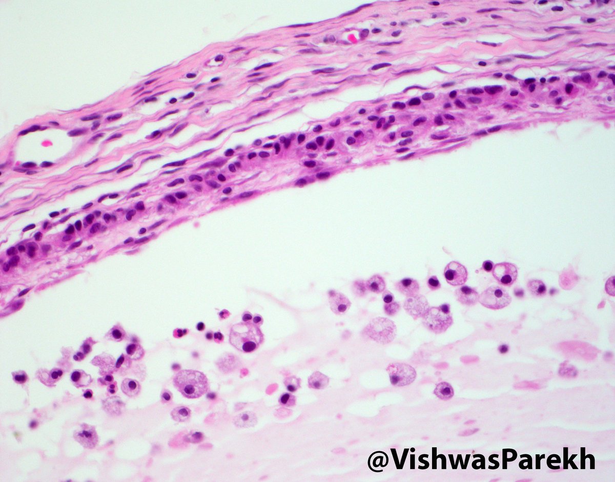 #Mucocele:#Lip. Minor #salivary #glands.#Muciphages #Pathology #OralPath #Dermatopathology #Histology #HeadNeck #ENT