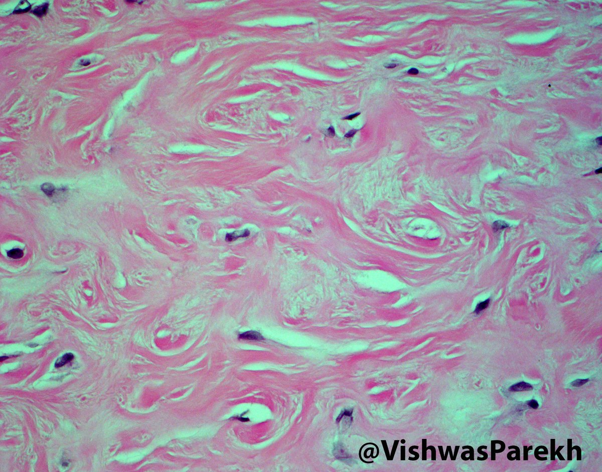VishwasParekh's tweet photo. #Sclerotic #Fibroma/#Storiform #collagenoma: Multiple a/w #Cowden #syndrome #PTEN #dermatopathology #genetics #skin https://t.co/D2K1u92Sis