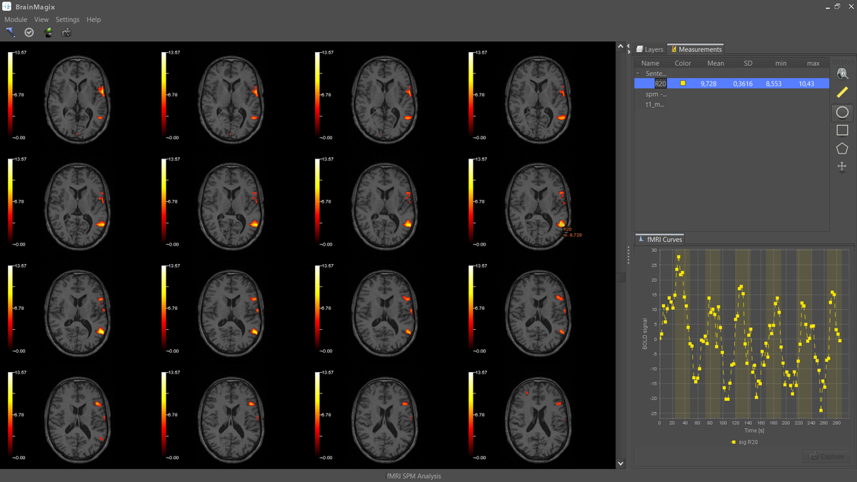 Imagilys's tweet photo. Our CEO @LaurentHermoye's language areas (i.e. Broca's and Wernicke's areas) in #BrainMagix 2.0 https://t.co/cda6UBxD5B
